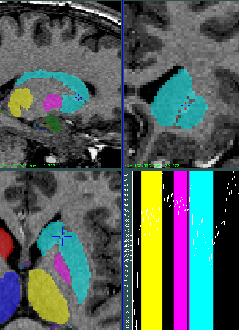 striatum internal capsule