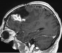 RegLib C37: tumor resection\ 200x171