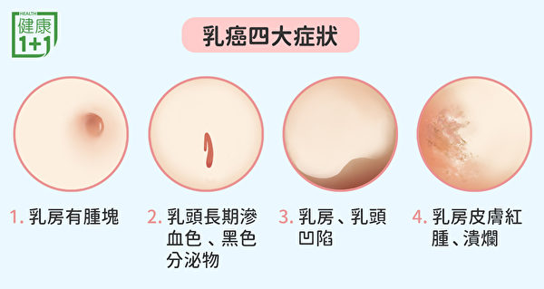 常见的乳癌症状包括乳房有肿块、乳头长期渗血等。（健康1+1／大纪元）