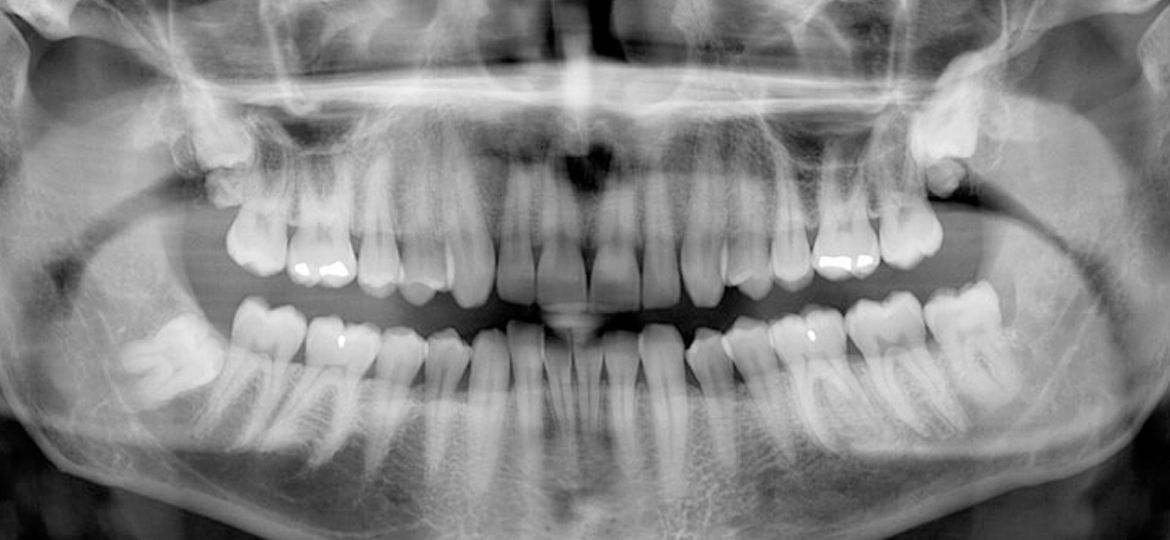 Inference on Panoramic X-ray