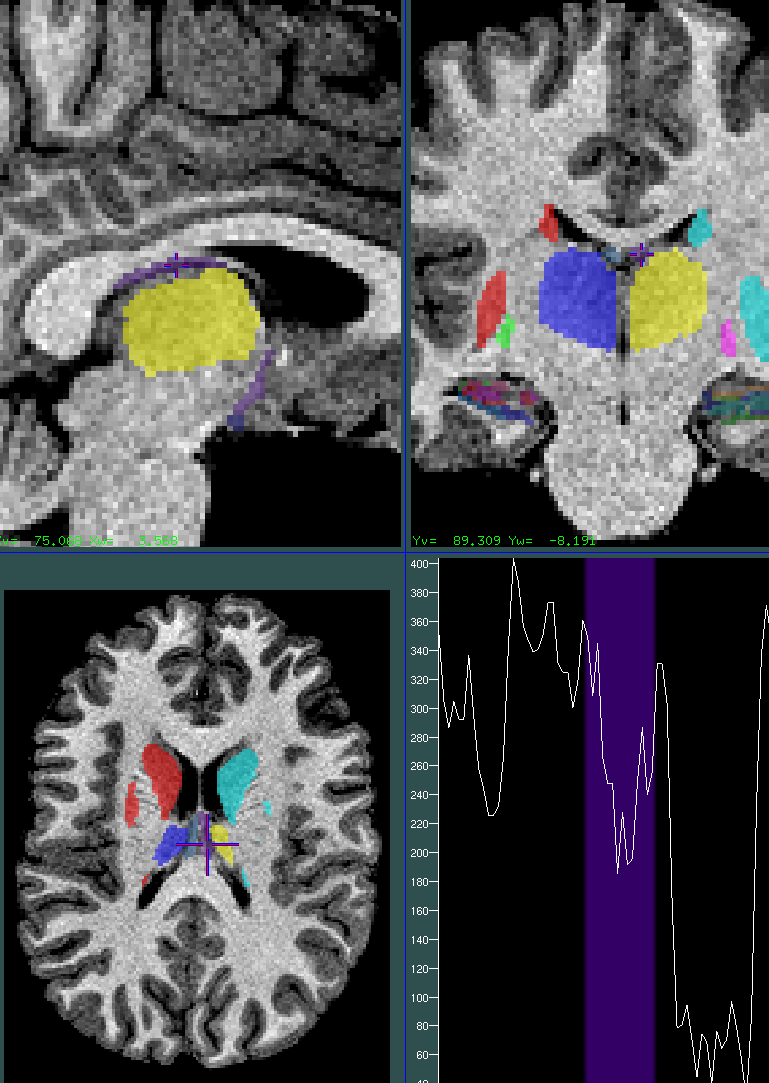 white_matter0.75