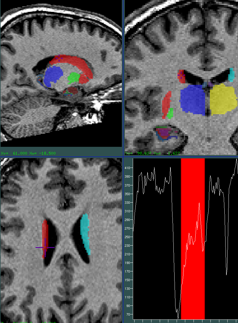 Striatum body oversegmentaed