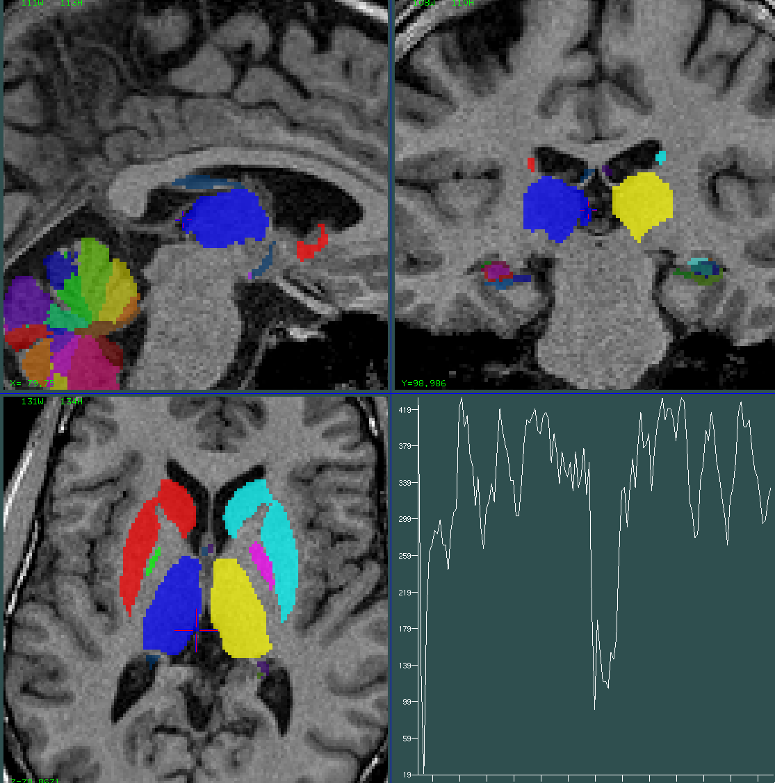 thalamus 0.5