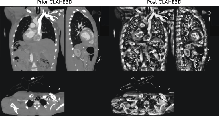 Preview of the effect CLAHE3D has on a medical volume