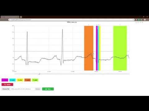 Intro to ECG Label Sys