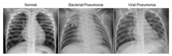 Examples of Chest X-Rays