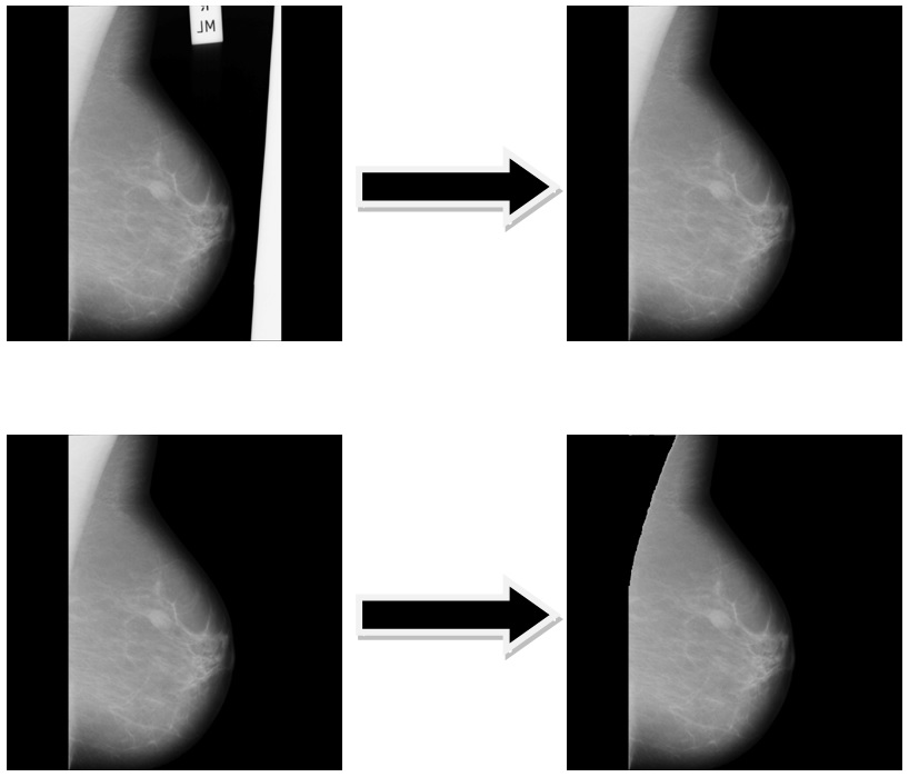 Breast Mammogram ROI Extraction