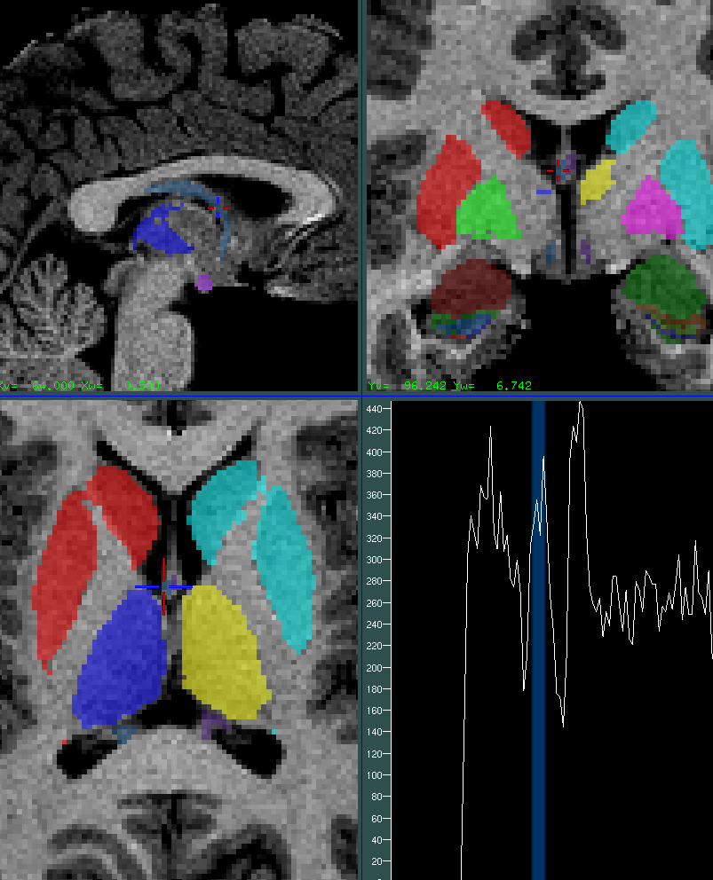 white_matter1