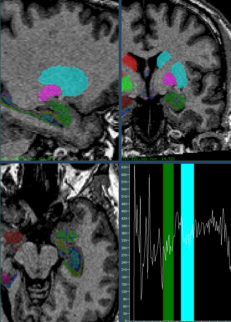 amygdala 1