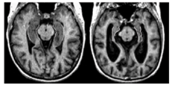 MRI Image courtesy of Sunnybrook and Women's College of Health Sciences Center