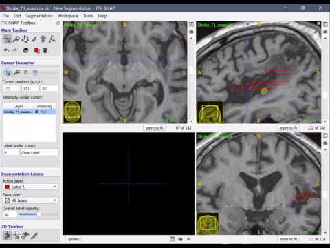 Manual lesion segmentation