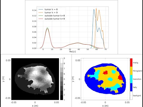 Heterogeneously Dense breast detailed demonstration of iterative unsupervised machine learning segmentation technique