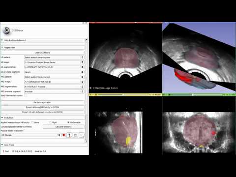YouTube video: MRI-US Fusion for Prostate HDR Brachytherapy