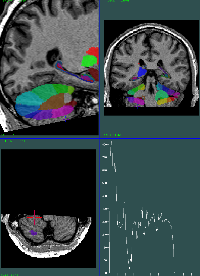 cerebellum cut off