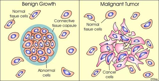 difference between Malignant and Benignt