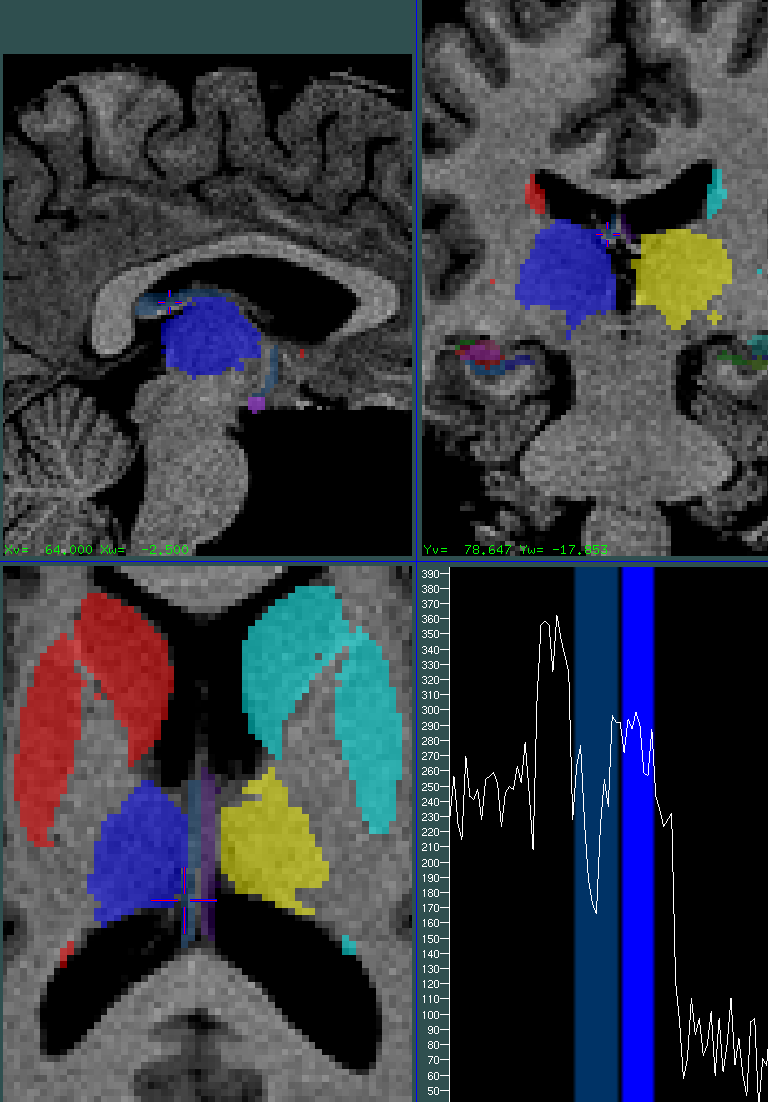 white_matter0.5