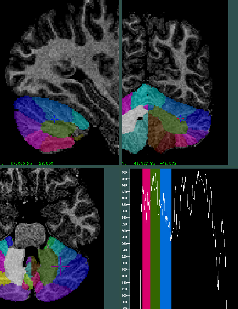 cerebellum 0.75