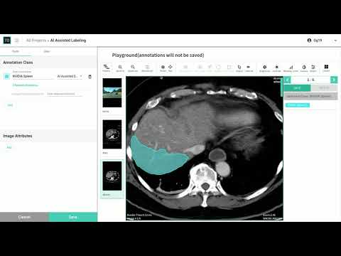 AI Assisted Spleen Segmentation