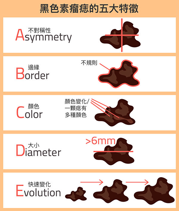 由于表现为斑痣的黑色素瘤是最致命的皮肤癌，美国癌症协会提供ABCDE自我检查方法。（Shutterstock/大纪元制图）