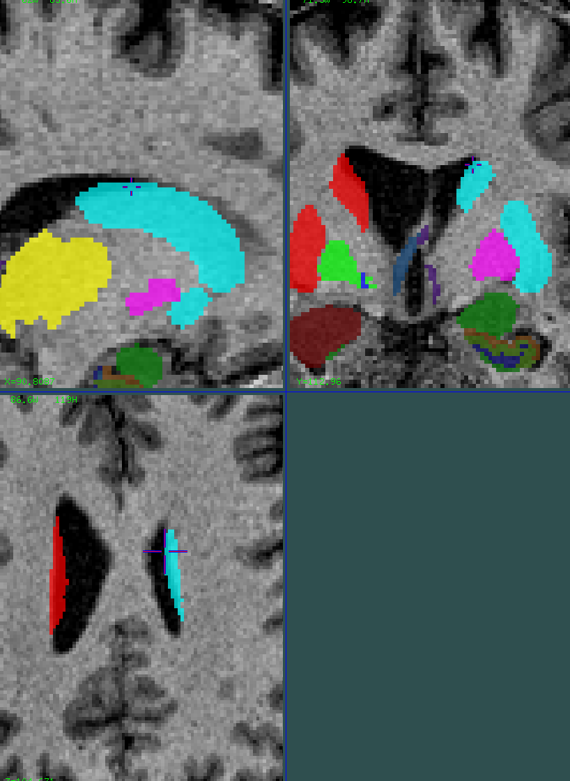 striatum 0.75