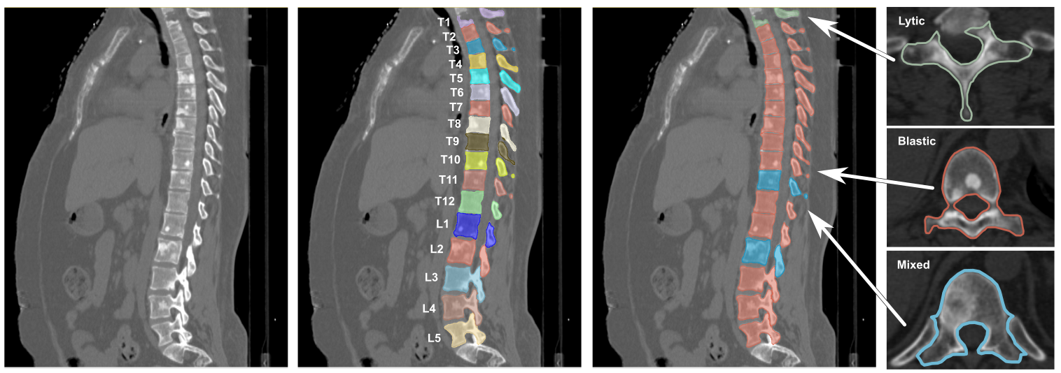 Spine-Mets-CT-SEG dataset