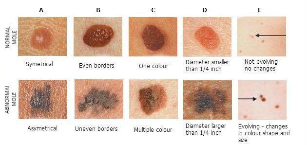 melanoma-image