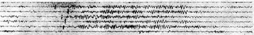 eeg trace