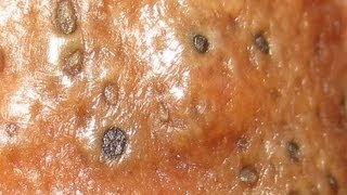 Black & White Heads On Nose Part 3