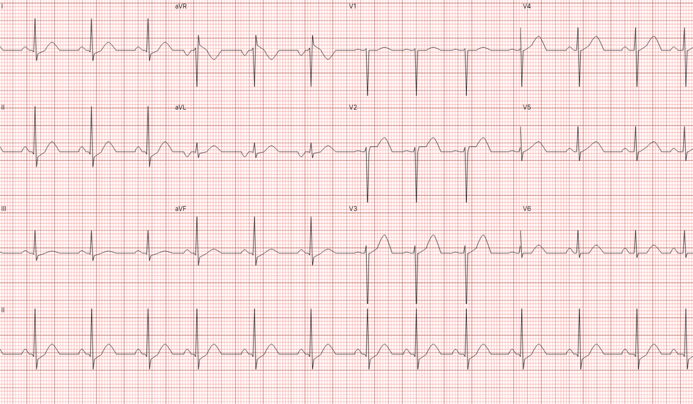 12 Lead ECG