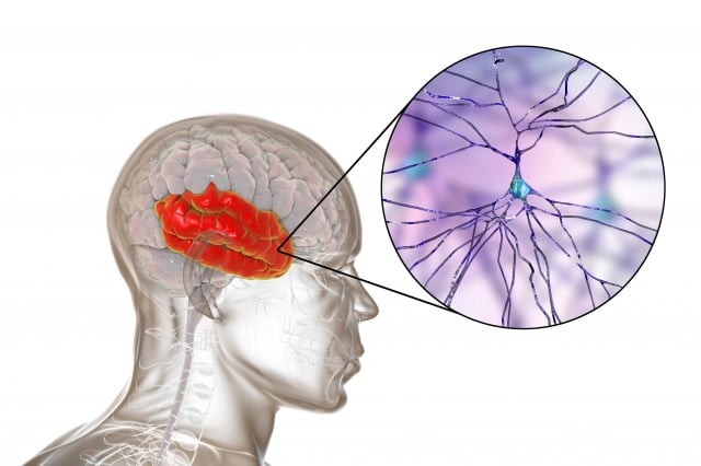 额颞叶失智症（Frontotemporal dementia，简称FTD）是一种罕见的神经退化性疾病，也被称为额叶痴呆或额叶退化症。（123RF）