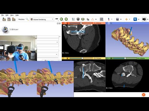 Demo: Pedicle screw insertion in virtual reality using Slicer
