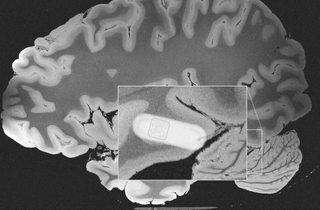 MRI of a brain, with a section zoomed in with a light cylindrical mass, that has some kinds of 2D barcode on it