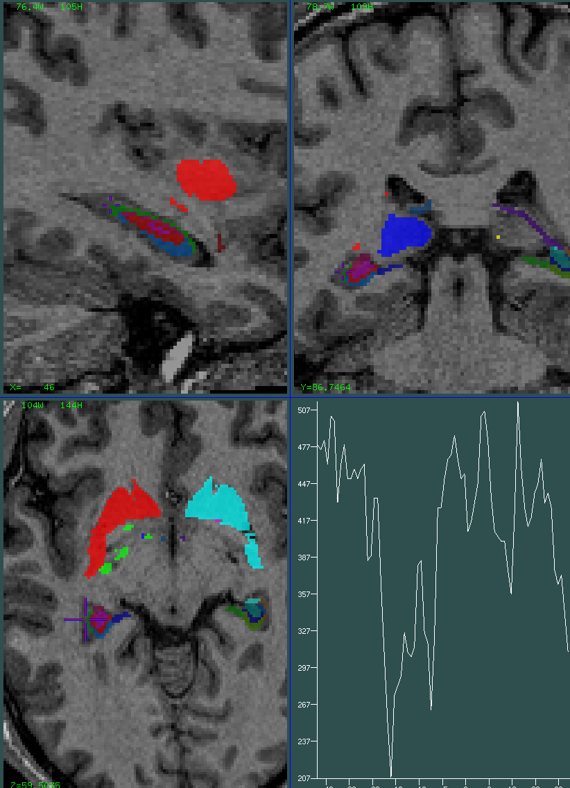 hippocampus 0.5