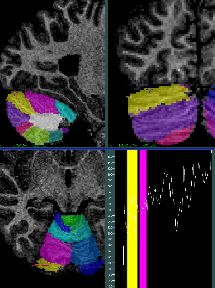 cerebellum oversegmentation