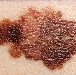 Picture of a melanoma