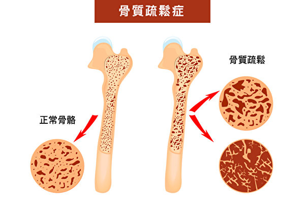 FOSTA指标不需要测量骨质密度，就可以轻松预知罹患骨质疏松症的风险。（Shutterstock/大纪元制图）