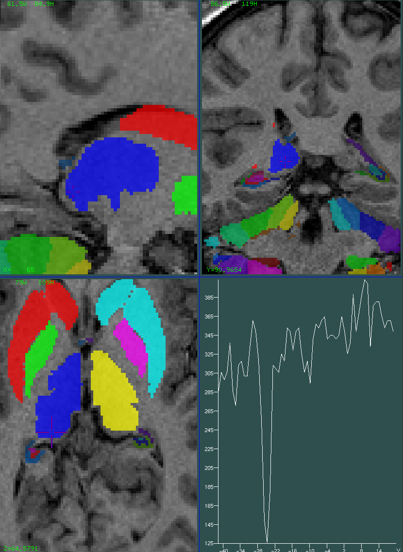 thalamus 0.75