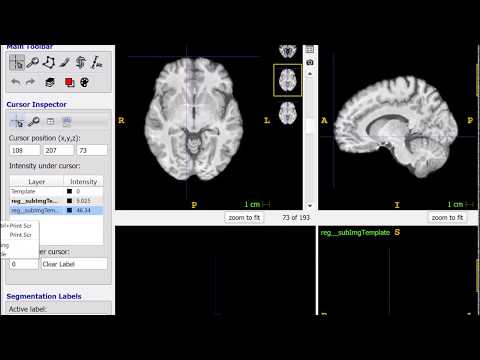 Comparing SyNCC vs. SyN