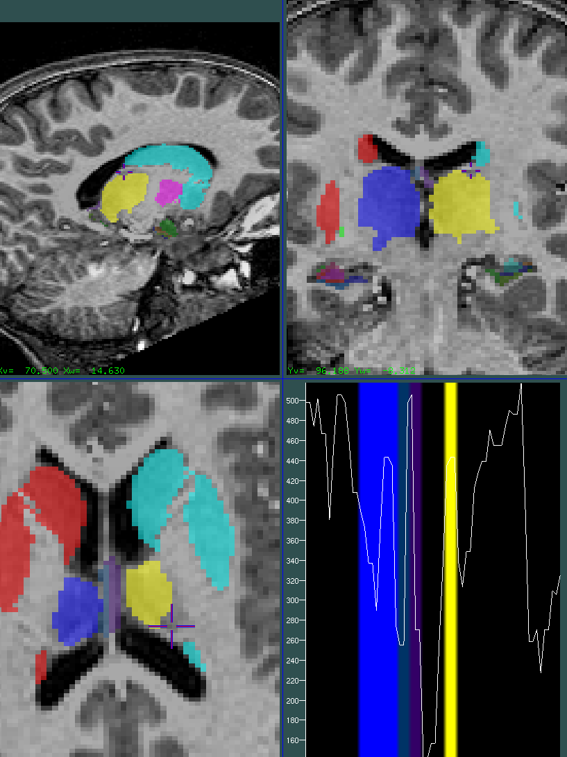 Thalamus undersegmentation