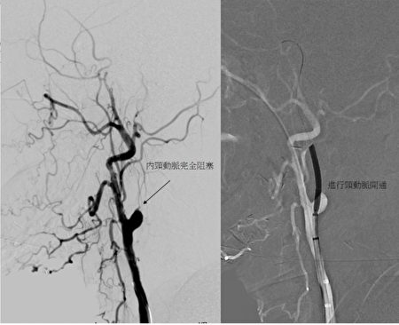 内颈动脉完全阻塞（左图），颈动脉开通（右）
