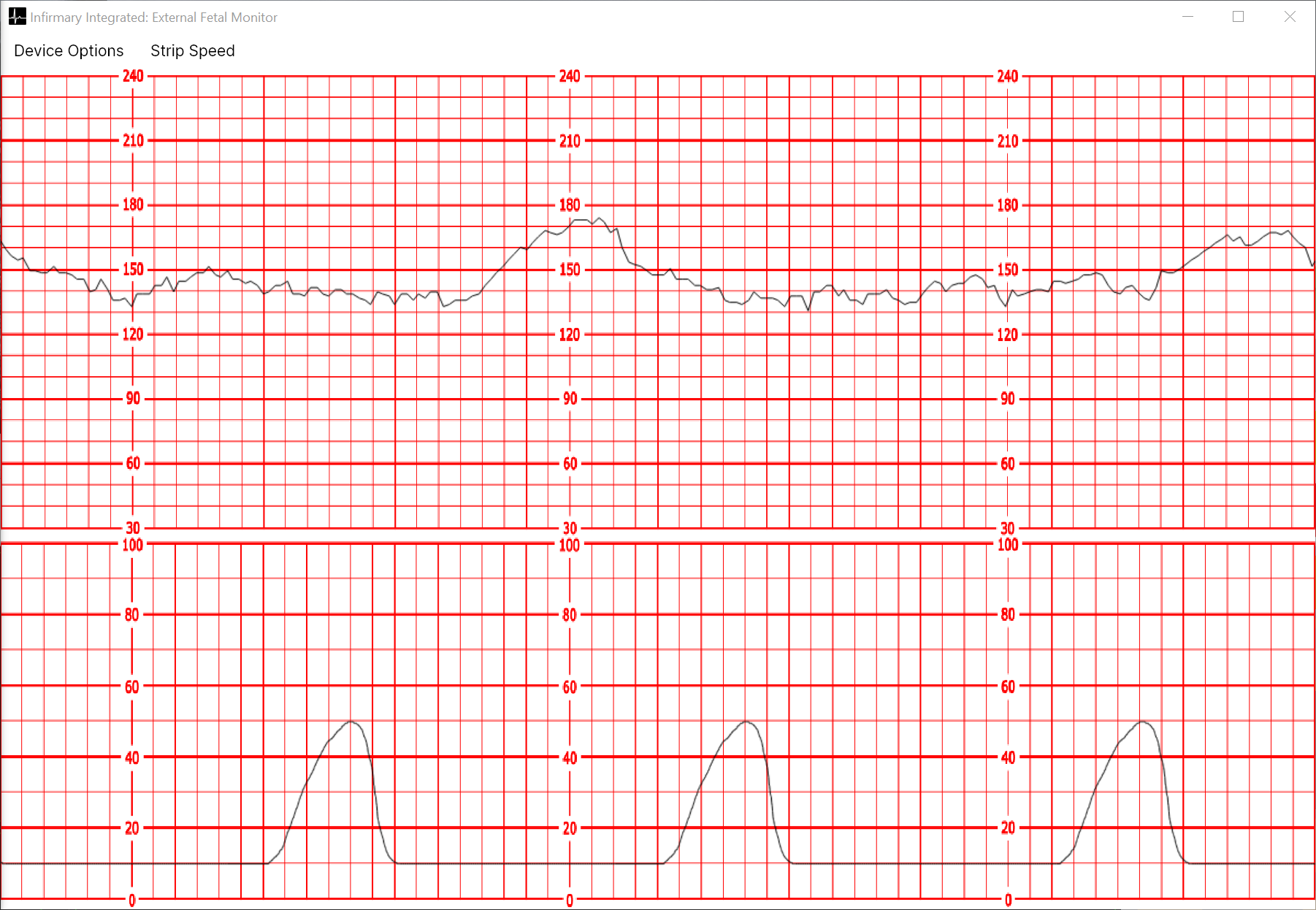 Fetal Heart Monitor