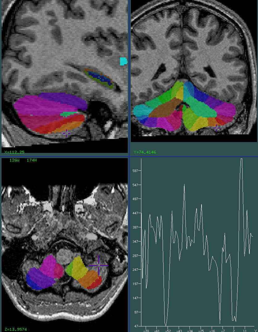 cerebellum 0