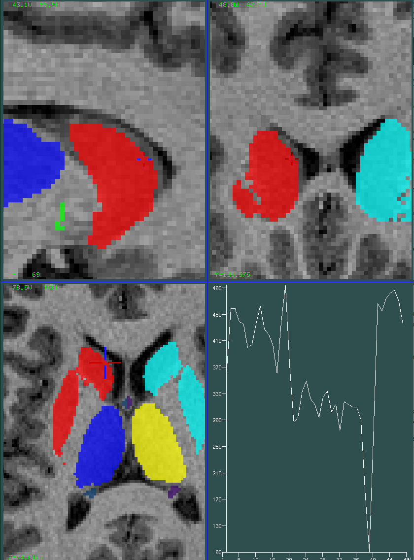 striatum 0.5