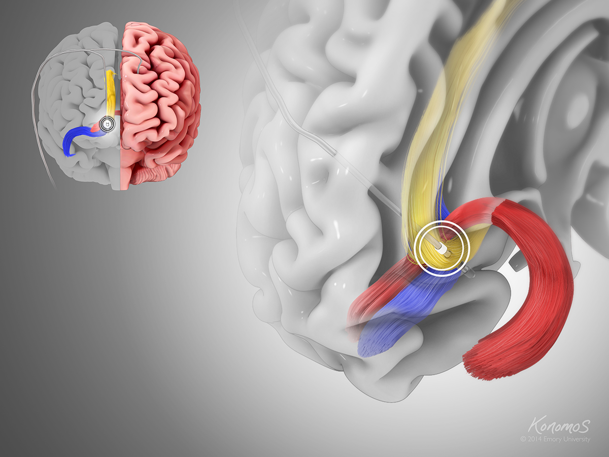 DBS of the SCCwm targets specific tracts in the brain that likely mediate the immediate effects.