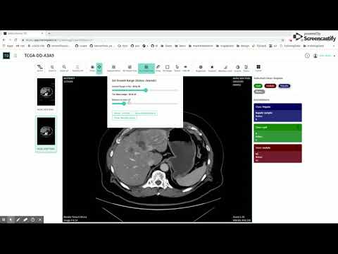 3D Growth Tool Using HU Value