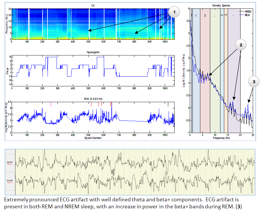 ECG Artifacts