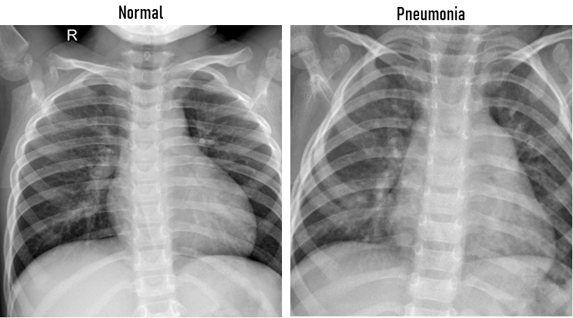 Pneumonia Detection