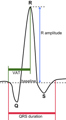 QRS complex