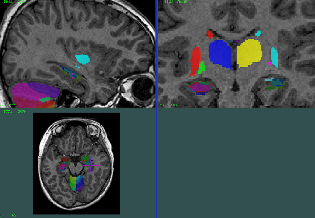 hippocampus oversegmentation