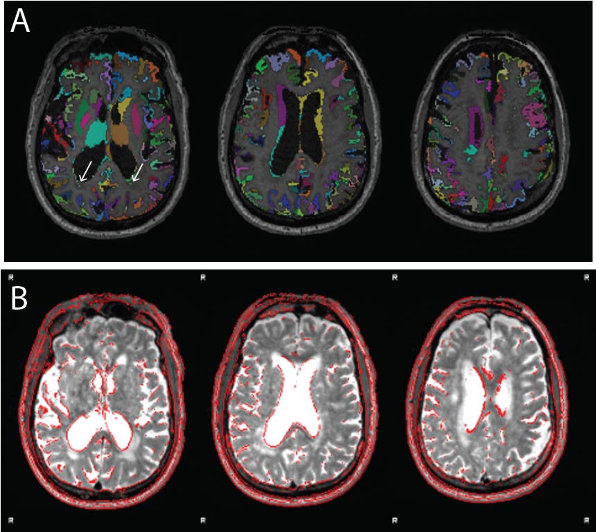 Figure 7. Example of white matter lesion misclassification as grey matter. (A) The labelled grey matter image is shown on the T1w. (B) T2* image from the same older adult subject indicating a significant volume of white matter lesions that are also notable on the T1w. Although performing segmentation on the T1w image using age-specific tissue priors is largely successful despite the large white matter lesion volume, some misclassification remains (white arrows in panel A). Images reproduced from the example subject’s QC report.